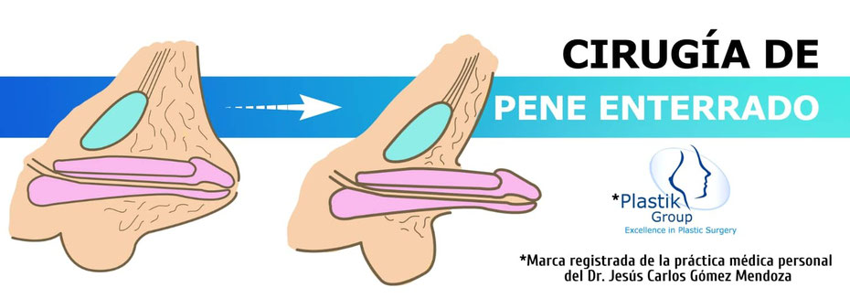 CIRUGIA DE PENE ENTERRADO