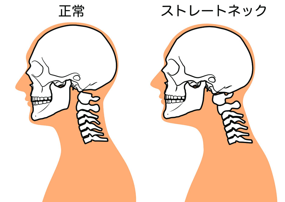 豊田市 接骨院Vivaceのストレートネック・巻き肩解説イラスト