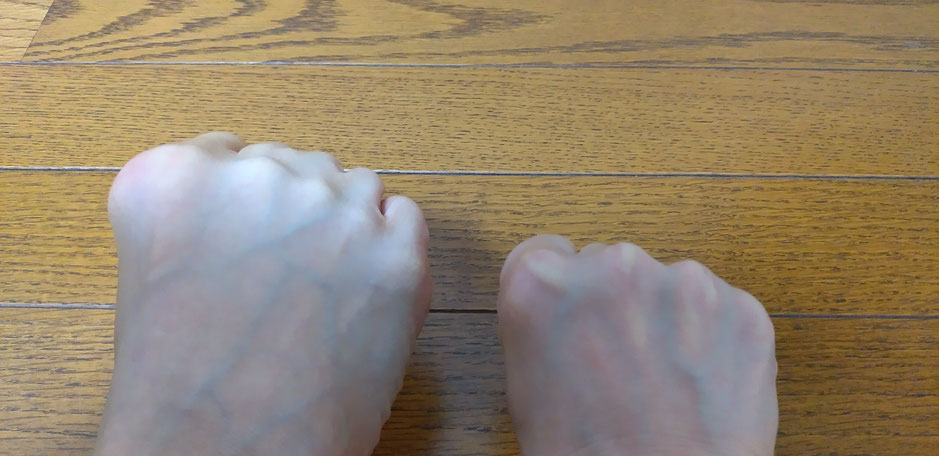 左が足指のぐー、右は手指。