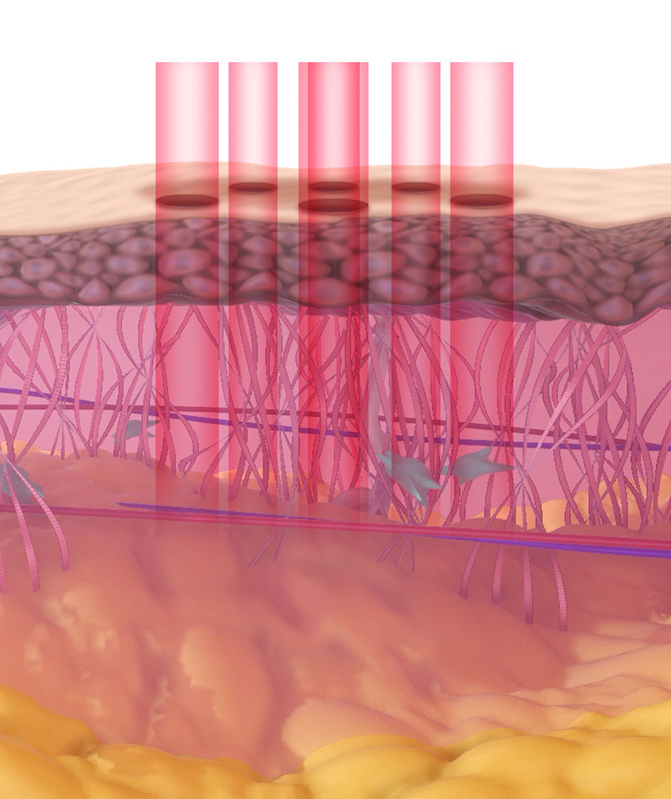 Was ist Laser-Behandlung in der Dermatologie?