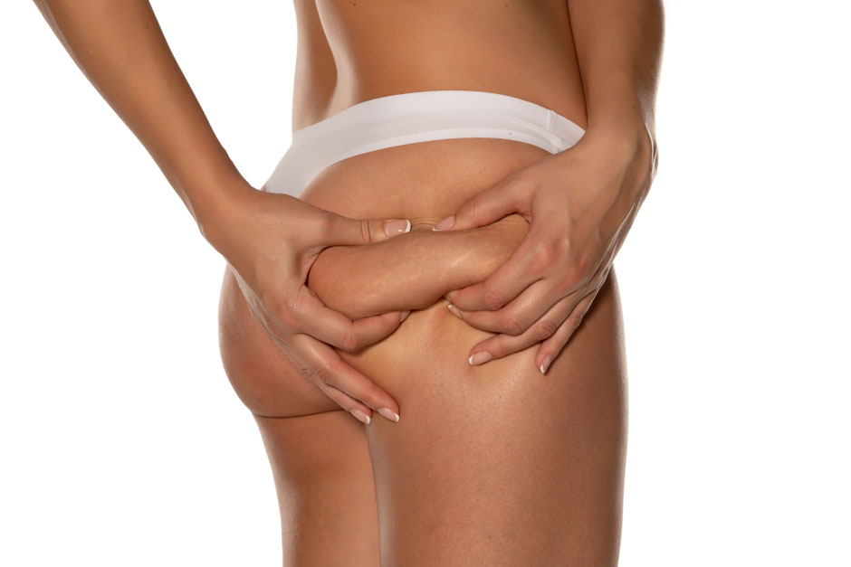 Was ist Cellulite und wie entsteht sie?