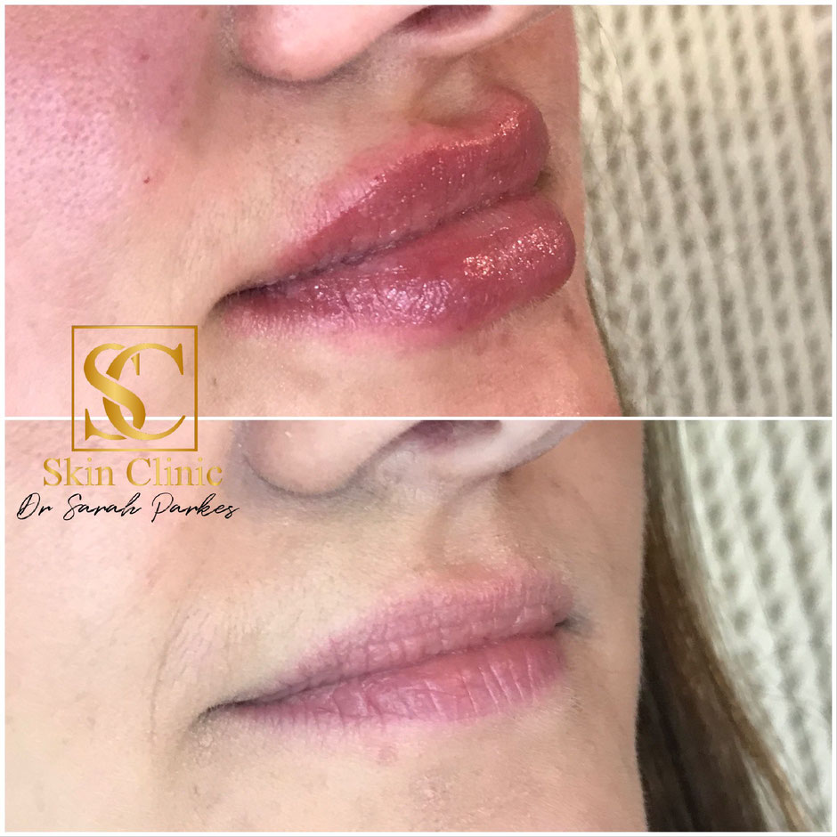 Lip filler before and after skin clinic swansea, Neath Bridgend