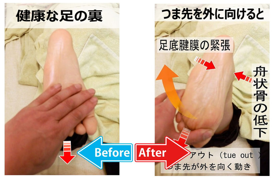 足底腱膜炎の原因