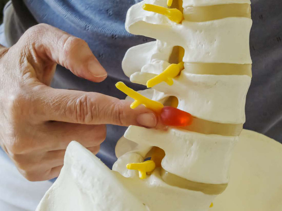 Dehydrated intervertebral disks can cause nerve impingement and pain