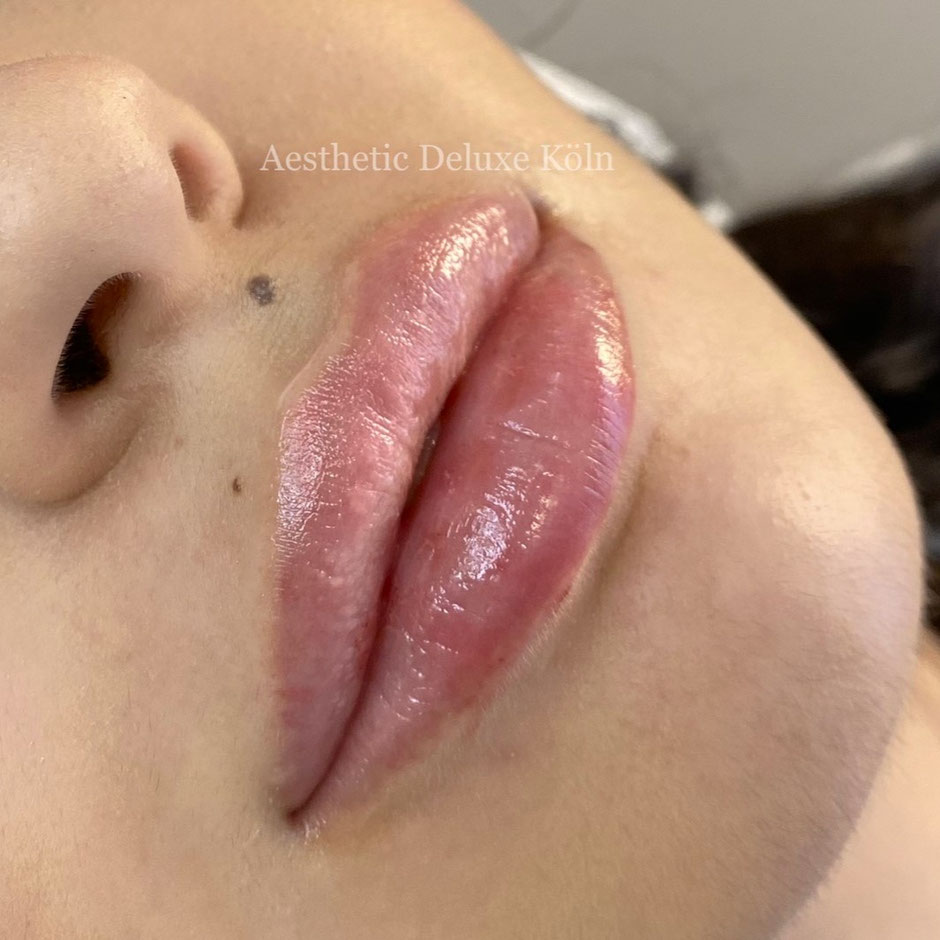 vorher-nachher Lippenaufspritzen mit Hyaluron Aesthetic Deluxe Köln Russianlips Hyaluronbehandlung Köln Bonn Düsseldorf Lippenkorrektur