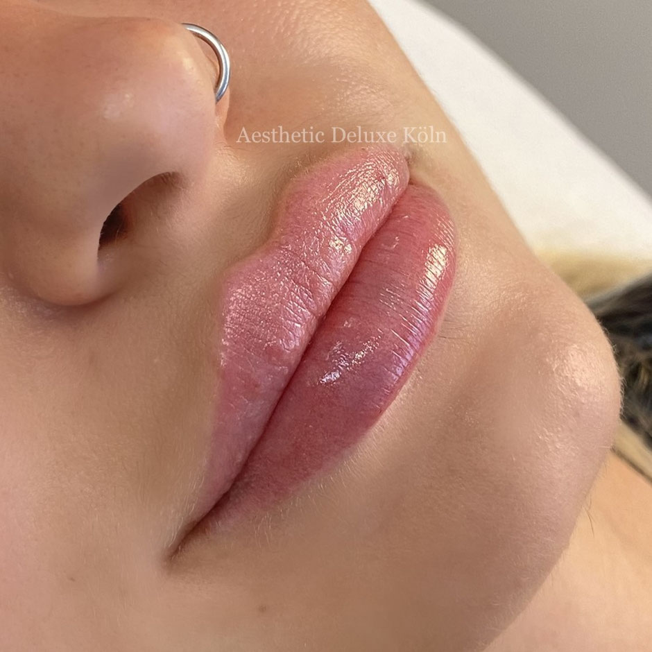 vorher-nachher Lippenaufspritzen mit Hyaluron Aesthetic Deluxe Köln Russianlips Hyaluronbehandlung Köln Bonn Düsseldorf Lippenkorrektur