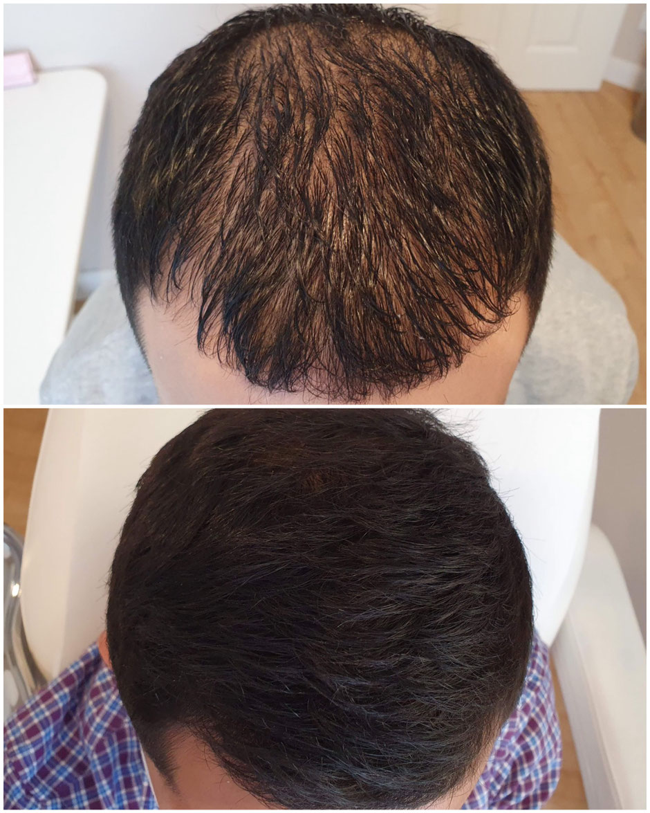 PRP PRF dichteres haar vorher nachher haarausfall in köln