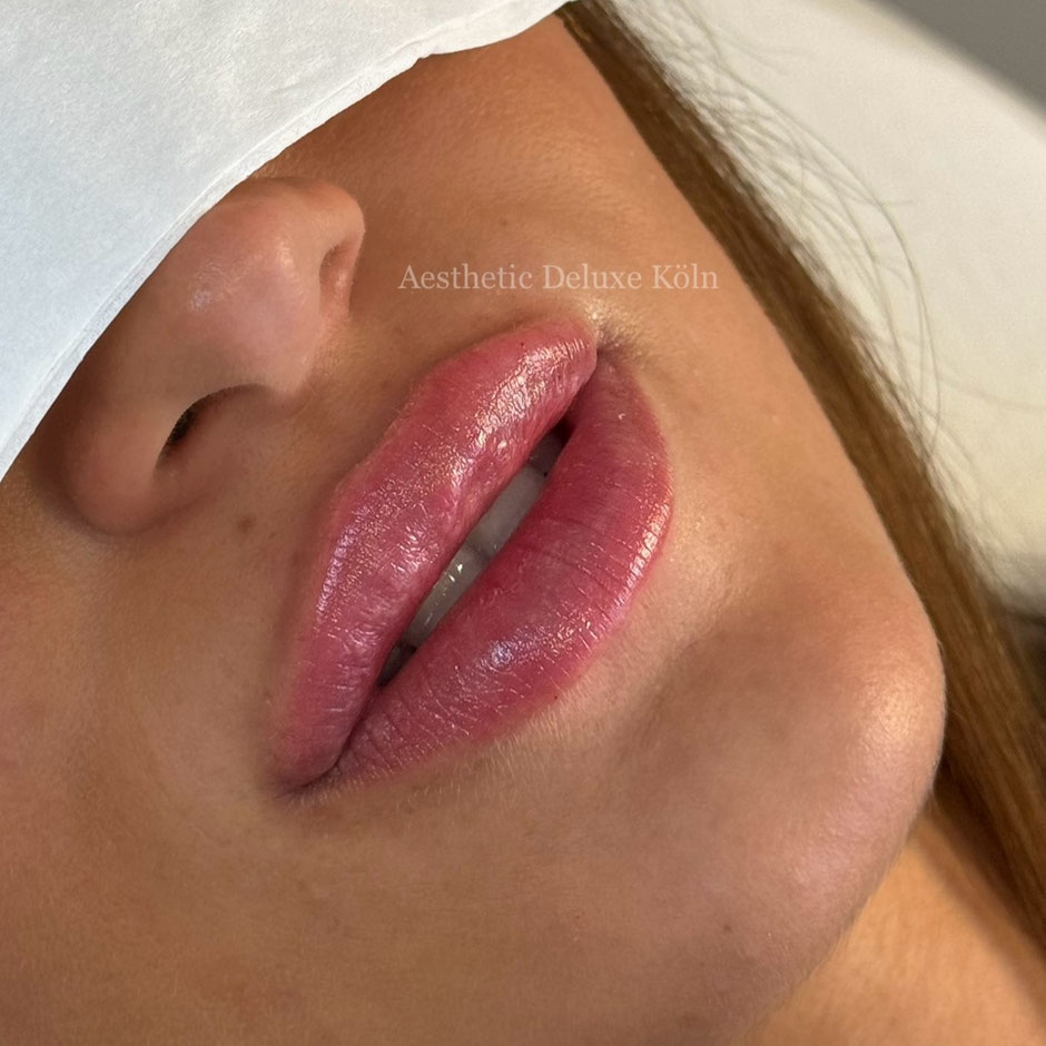 vorher-nachher Lippenaufspritzen mit Hyaluron Aesthetic Deluxe Köln Russianlips Hyaluronbehandlung Köln Bonn Düsseldorf Lippenkorrektur