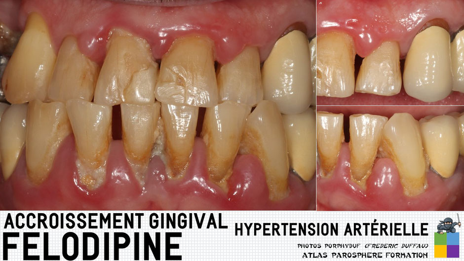 ParoSphère Formation | Atlas Accroissement gingivaux