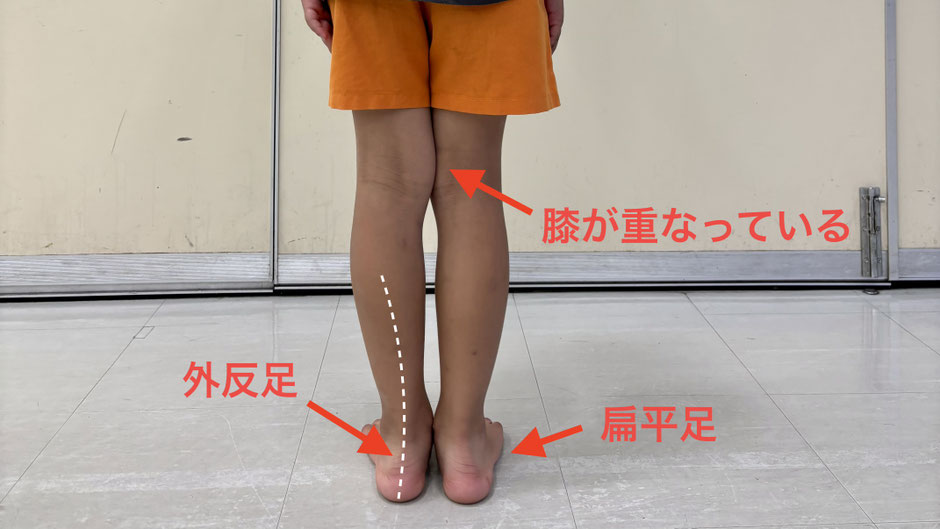 小学２年生の外反足、10歳までがタイムリミット