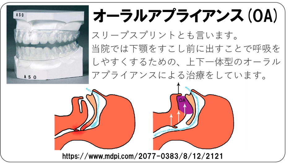 みつもり歯科医院では呼吸をしやすくするための、オーラルアプライアンスによる治療をしています。
