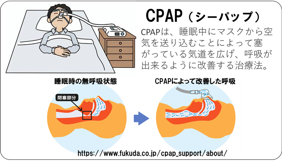 CPAPは、睡眠中にマスクから空気を送り込むことによって塞がっている気道を広げ、呼吸が出来るように改善する治療法。