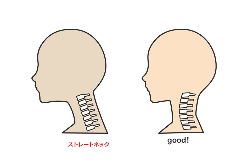 ストレートネックと正常頸椎の対比図