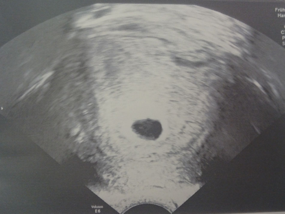 Mein Ultraschallbild in der 8.SSW