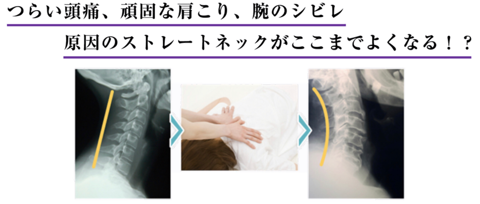 ストレートネックについて