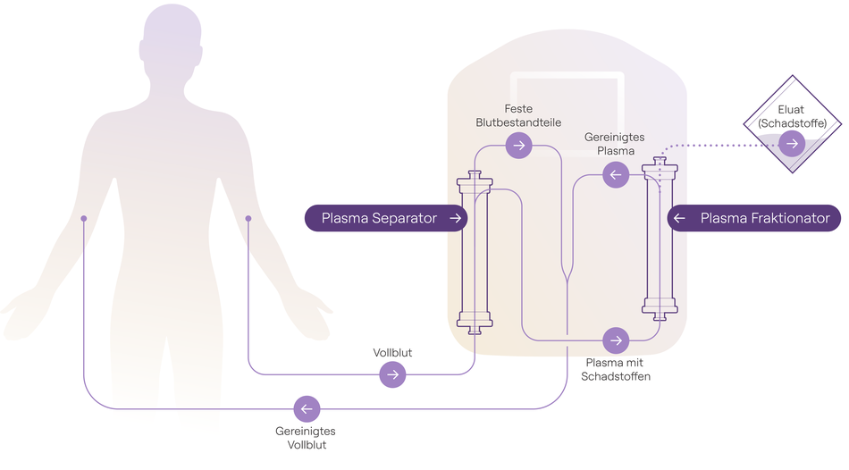 Das Pictogramm zeigt schematisch den Ablauf der Inuspherese: Das Blut wird im ersten Filter in Plasma und feste Bestandteile getrennt. Das Plasma wird in einem 2. Filter von Schadstoffen gereinigt und fließt mit den festen Bestandteilen wieder zurück.