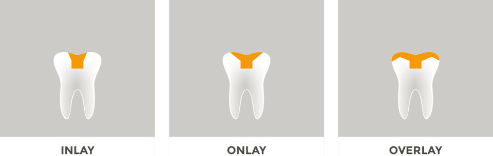 Inlay onlay overlay. Вкладки инлей онлей оверлей пинлей. Вкладка оверлей препарирование. Inlay onlay overlay. Inlay onlay overlay pinlay вкладки.