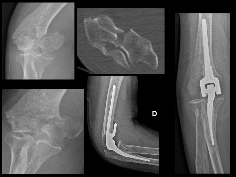 FRACTURE DU COUDE Dr Rémi chirurgien orthopédiste à Toulouse