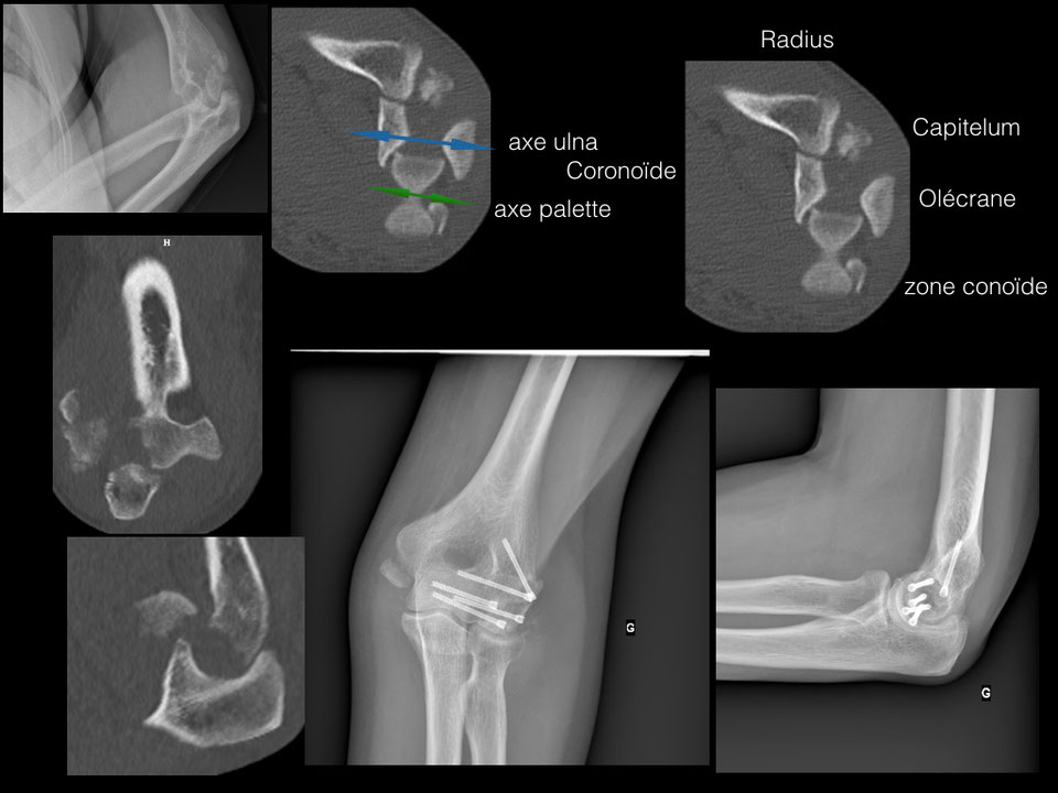 FRACTURE DU COUDE Dr Rémi chirurgien orthopédiste à Toulouse