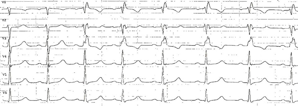 Rechtsschenkelblock im EKG - Fokus-EKG