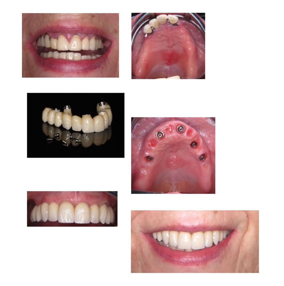 Zahnloser Oberkiefer Parodontitis der Implantatexperte