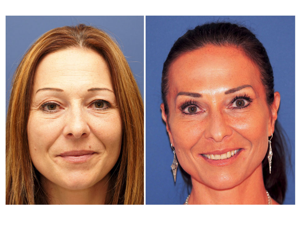 Botulinumtoxin / Botox , Krähenfüsse, Zornesfalten, Faltenbehandlung Schönheitsklinik Luzern