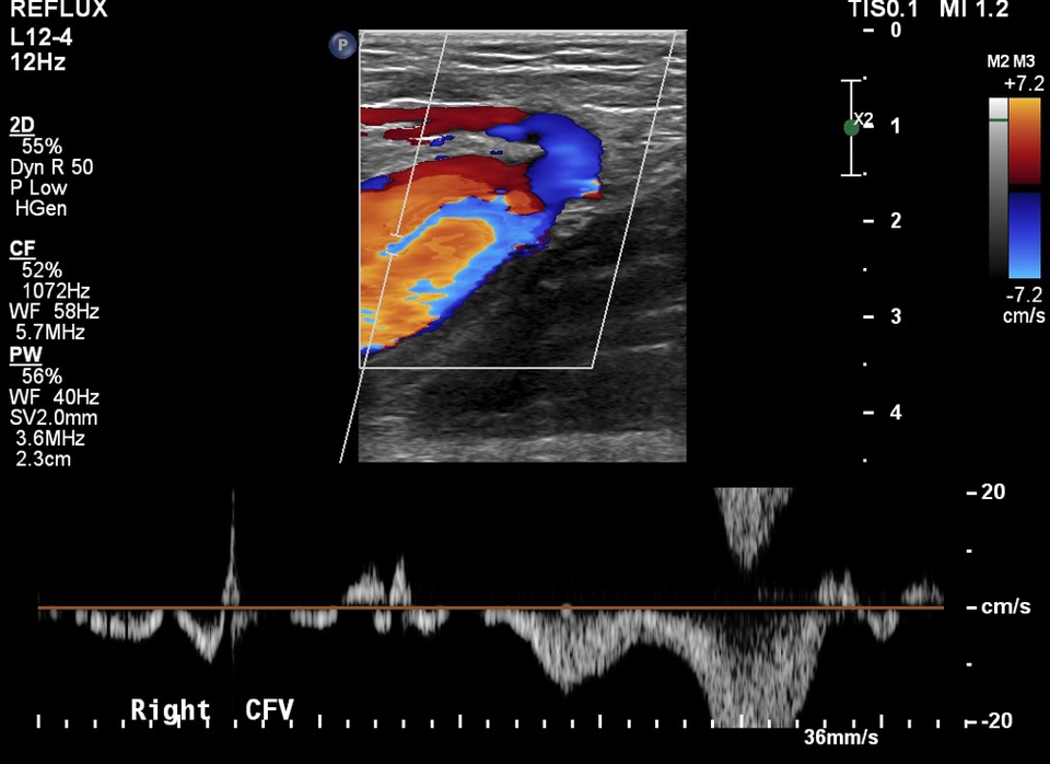 Is The Gold Standard Causing Misdiagnosis Varicose Vein Treatment
