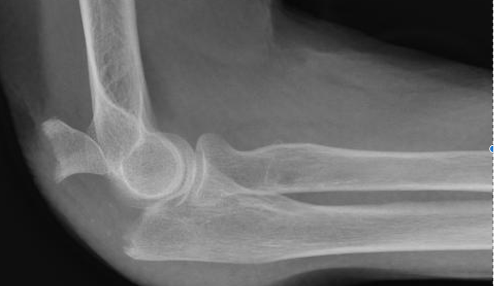 FRACTURE DU COUDE Dr Rémi chirurgien orthopédiste à Toulouse