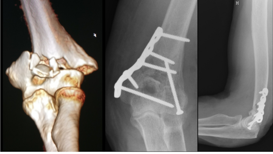 FRACTURE DU COUDE Dr Rémi chirurgien orthopédiste à Toulouse