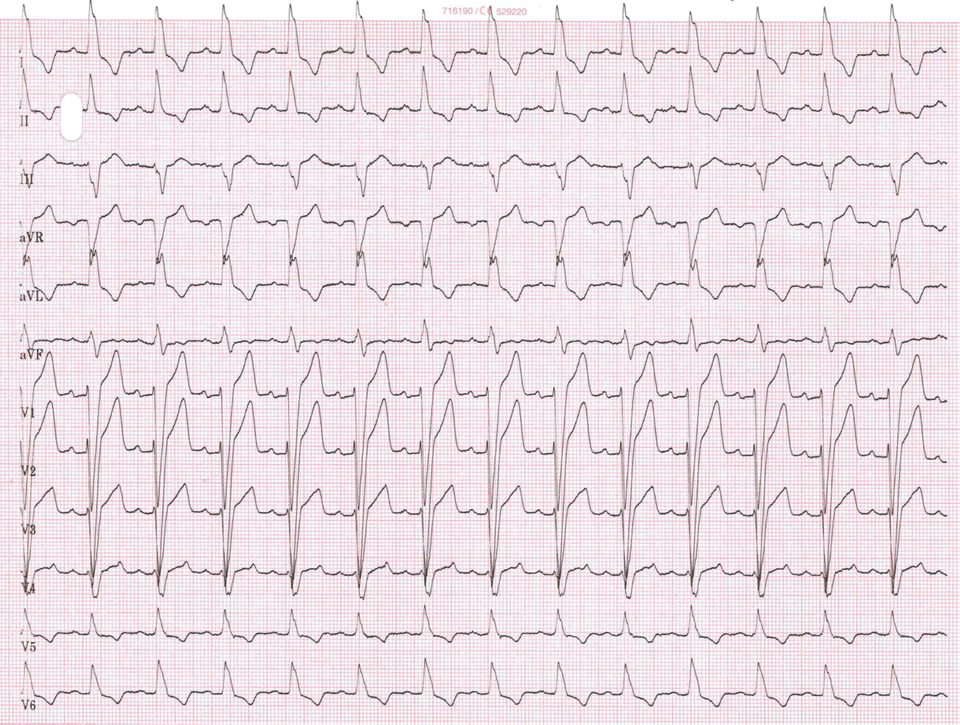 Linksschenkelblock Im EKG Fokus EKG linksschenkelblock-im-ekg-fokus-ekg