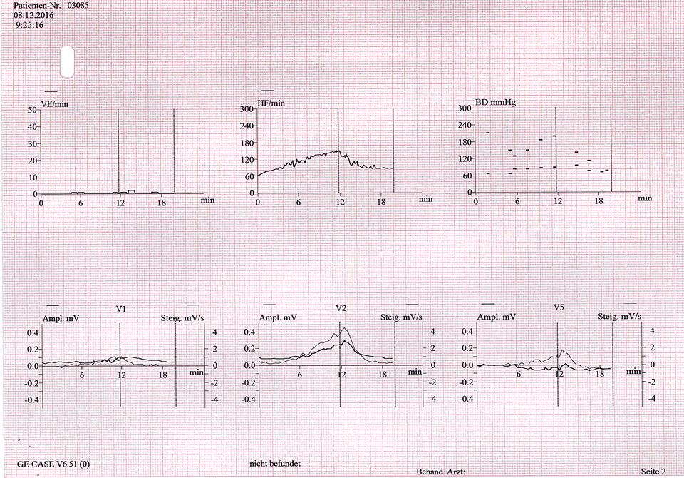 Wieviel Watt Sollte Man Beim Belastungs Ekg Schaffen Belastungs-EKG - Fokus-EKG