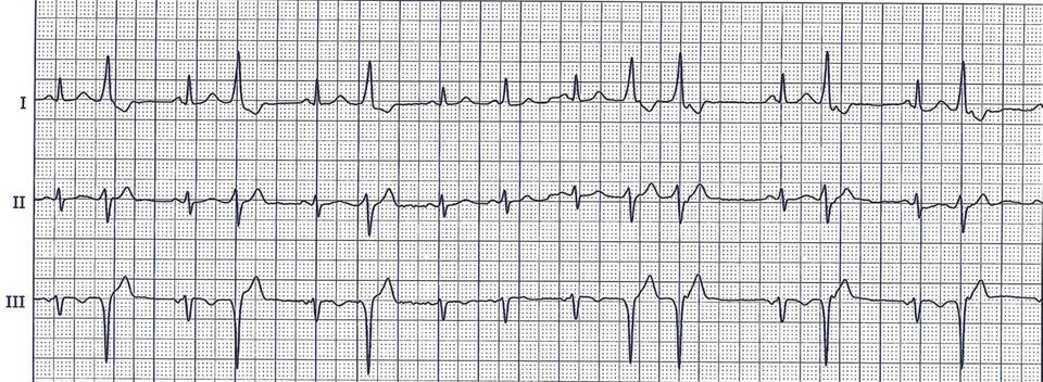 Ventrikuläre Extrasystolen - Fokus-EKG