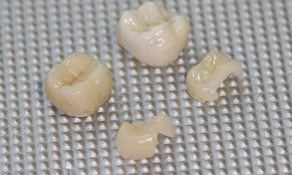 Teil - Kronen & Onlays schonen Zahnhartsubstanz - Zahnarzt Hauzenberg - Dr. Erhard