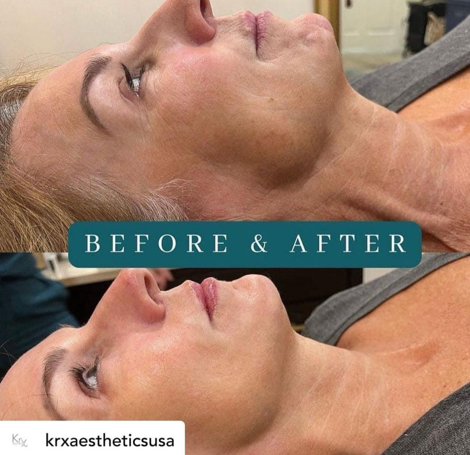 Bio Botox Behandlung Basel