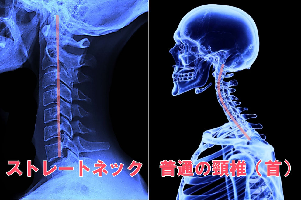 堺市パーソナルジム　姿勢改善