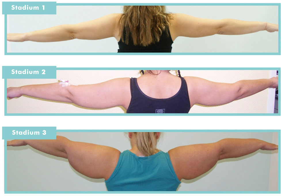 Lipodem Diagnose Und Behandlung Hautarzt Dusseldorf Mvz Dr Cornely