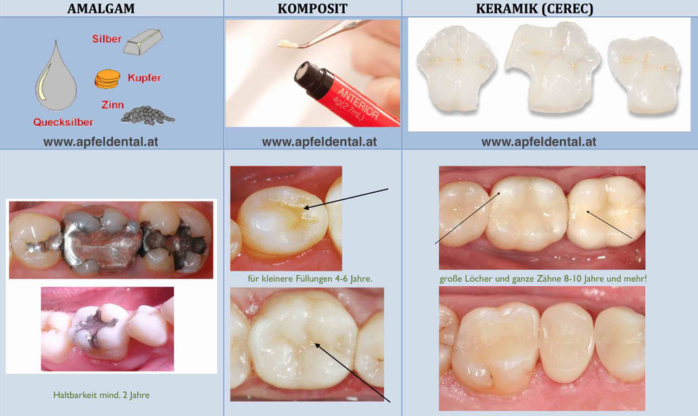 Was ist eine Zahnfüllung? für Bambus Zahnbürsten und Zahnpflege