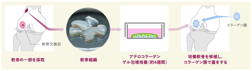 スポーツや怪我（外傷性軟骨欠損症）、疾患（離断性骨軟骨炎）などによって傷ついた軟骨を修復する「再生医療」の一つです 軟骨は一度損傷を受けると自然に修復することがほぼ期待できない組織ですが、軟骨細胞そのものには増殖する能力があります。そこで支障のない部位から、患者さんの正常軟骨組織の一部を少量採取し、体外で特殊な培養技術（アテロコラーゲンゲルをスキャホールドとして用いる）を用い、十分な量と安定した形状（三次元培養）に増殖させます。そして得られた培養軟骨を軟骨欠損部に移植するという治療法が「自家培養軟骨移植」