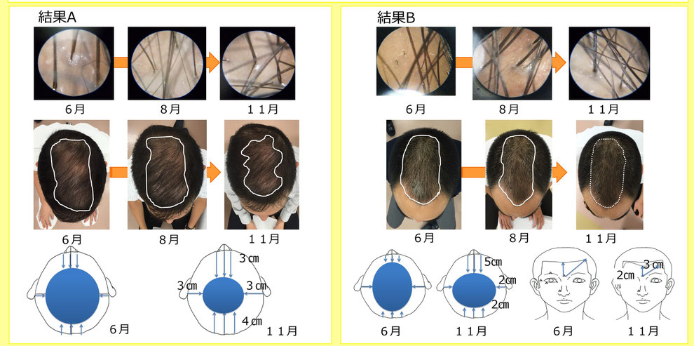 薄毛に対する鍼灸刺激を学会発表しました