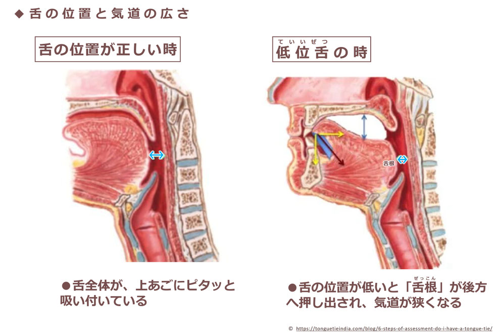 「舌の位置と気道の広さ」 ※舌の位置が低い(低位舌)と、舌根(ぜっこん)が後方に押し出され、気道が狭くなる