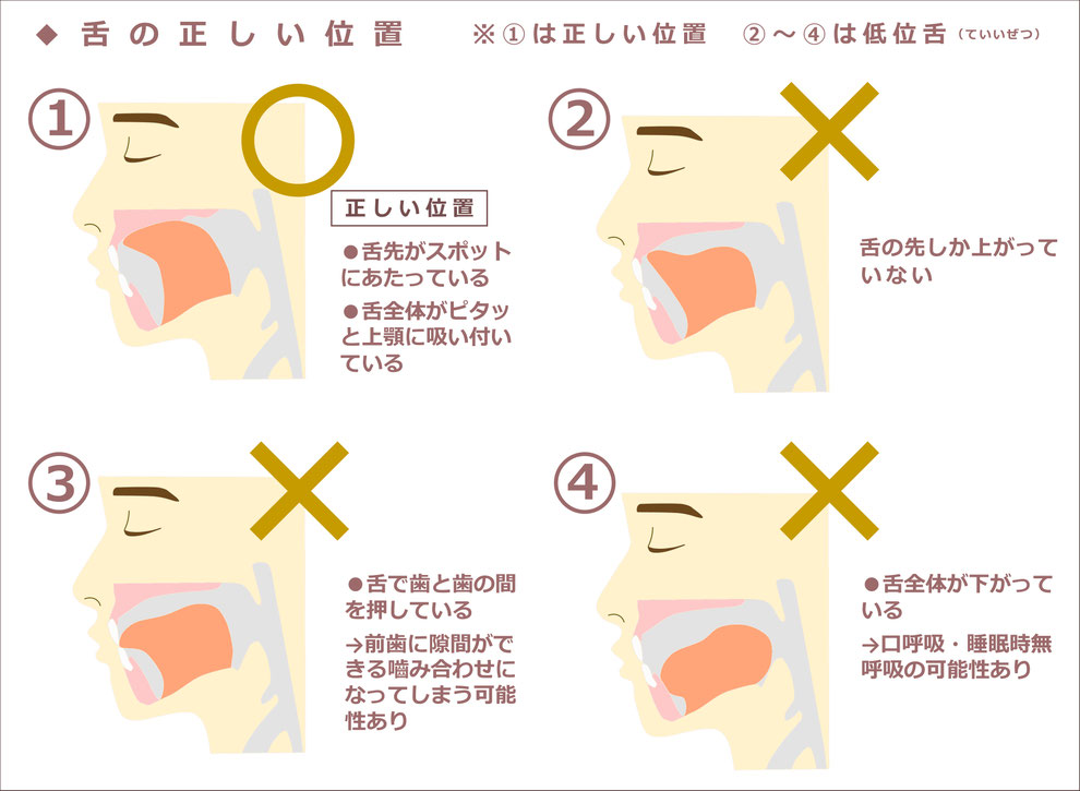 「舌の正しい位置」
