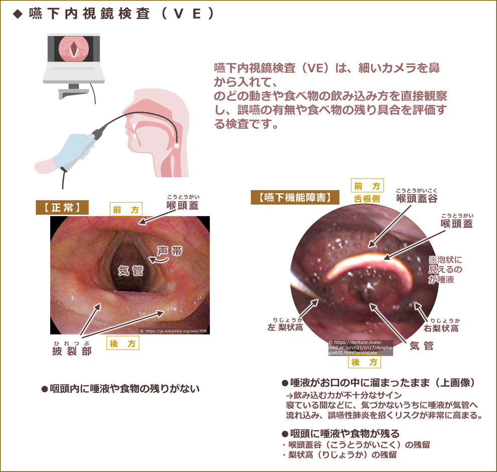 嚥下内視鏡(VE)とは