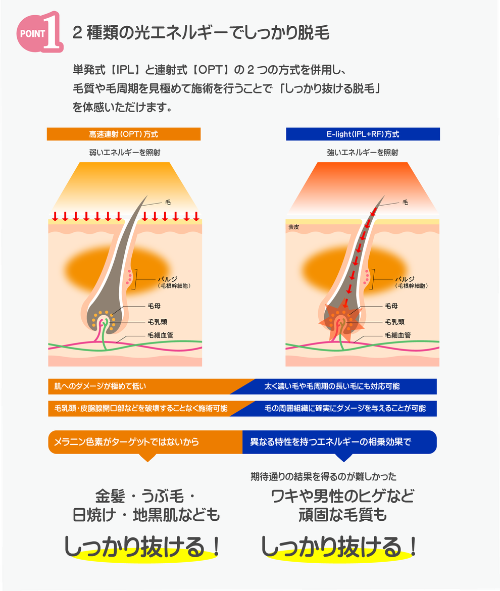 2種類の光エネルギーでしっかりと脱毛