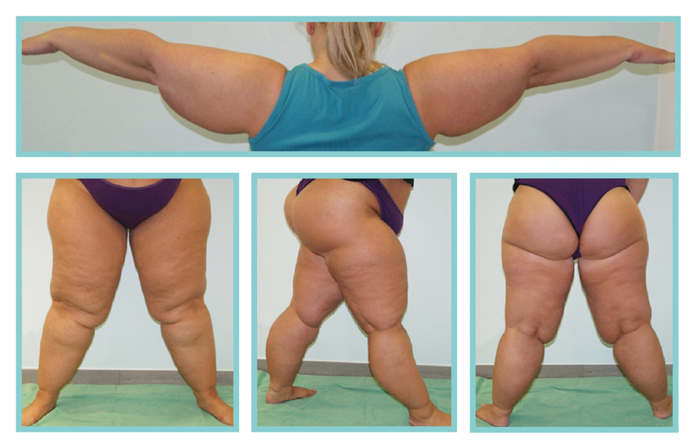 Lipodem Diagnose Und Behandlung Hautarzt Dusseldorf Mvz Dr Cornely