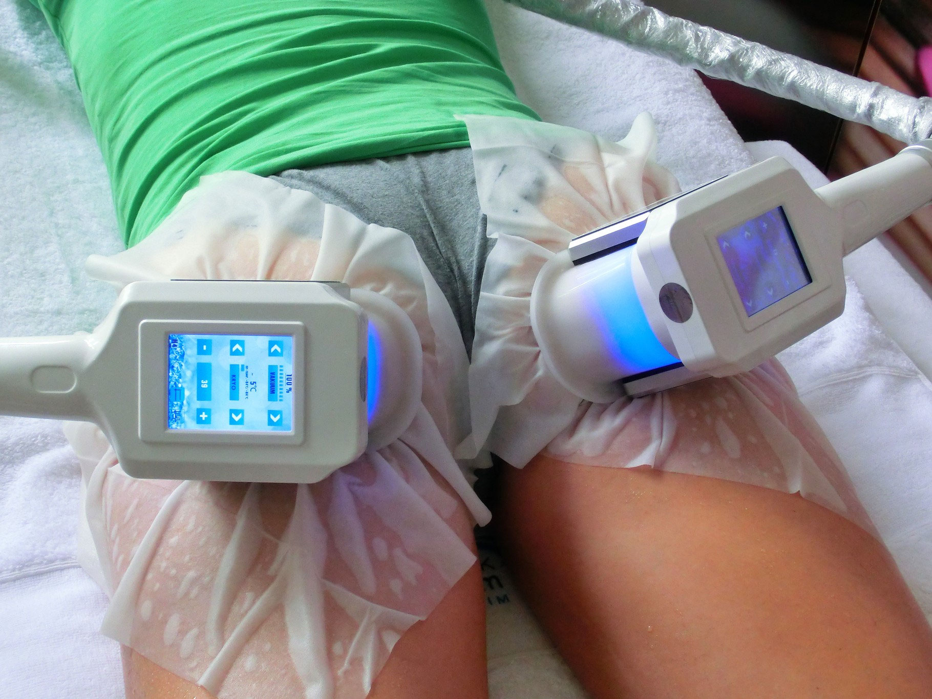 Kryolipolyse beim Facharzt Aesthetik Zentrum Laupheim