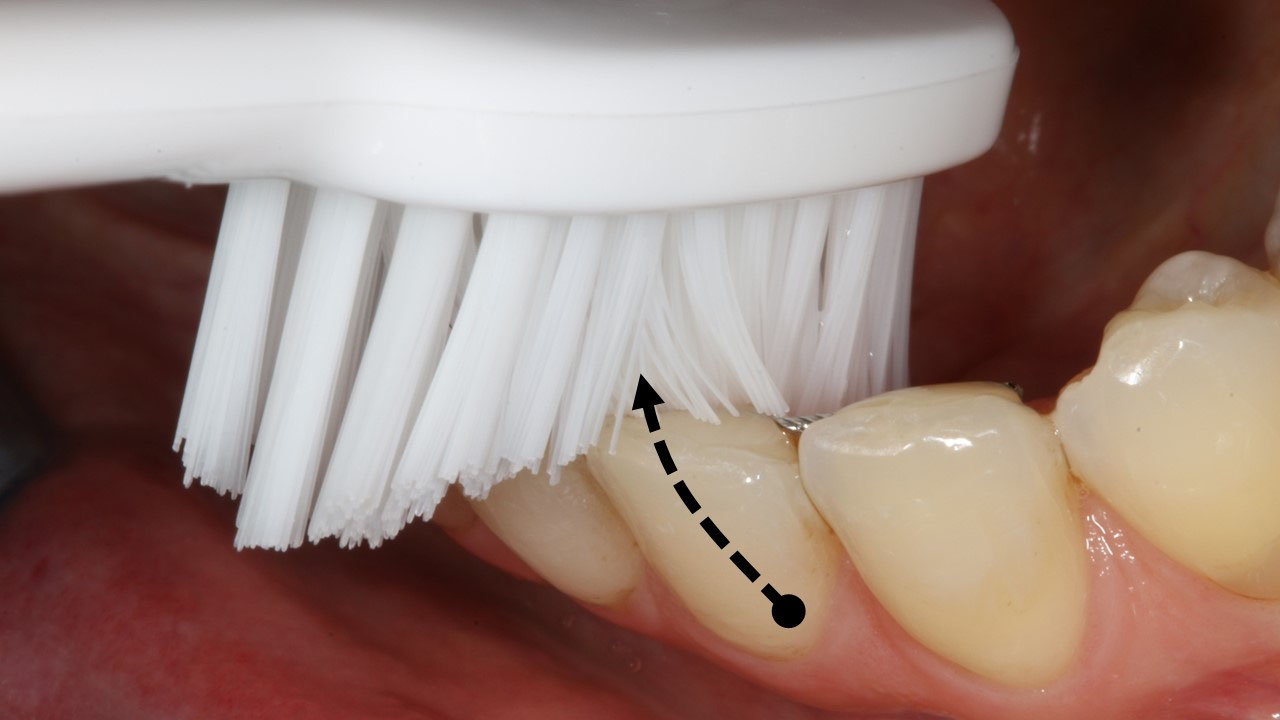 La technique du rouleau simplifiée ParoSphère