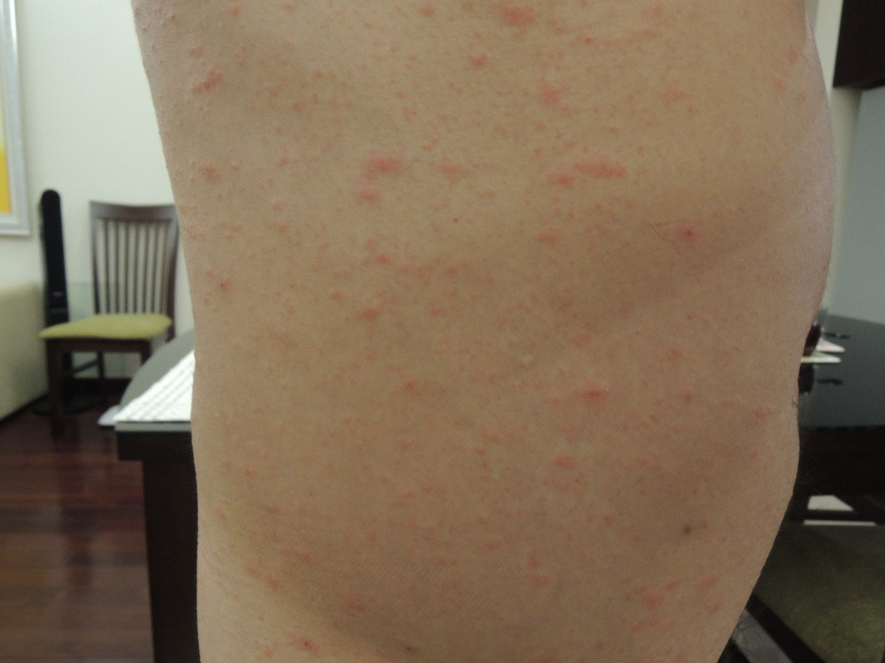 1週間目 ジベルばら色粃糠疹