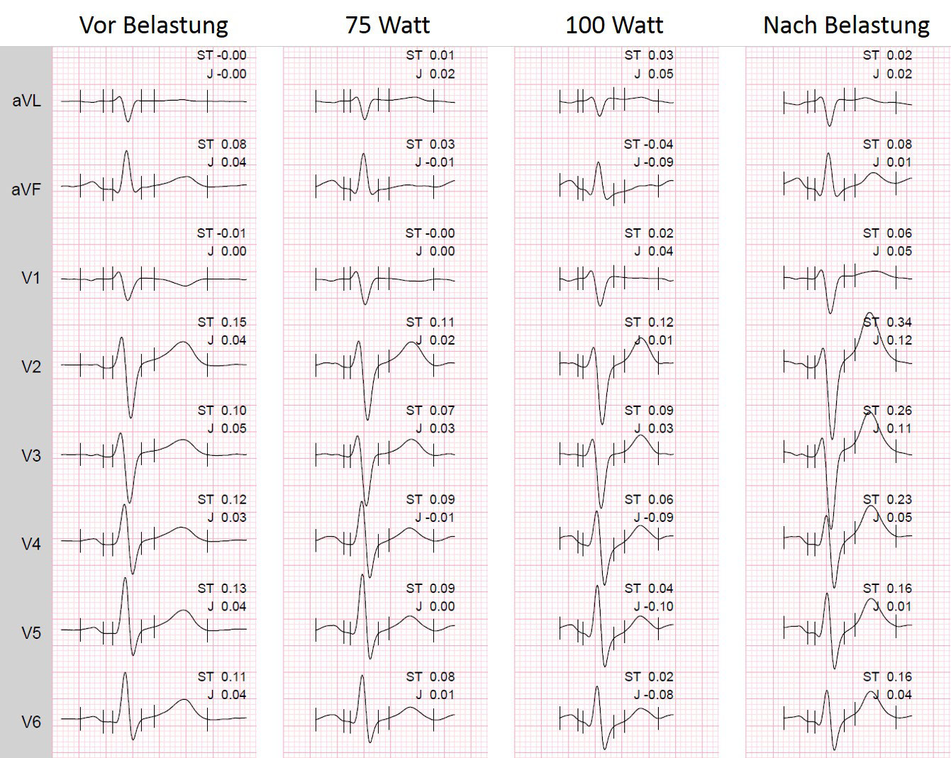 Ischämierdiagnostik mittels BelastungsEKG FokusEKG