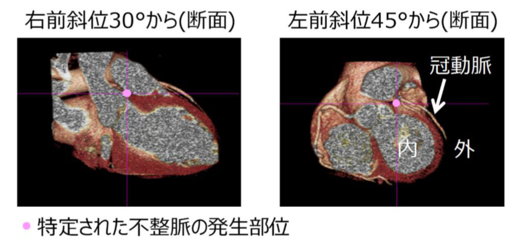 心磁図と心臓CT画像の合成により、不整脈の発生部位を高い精度で特定