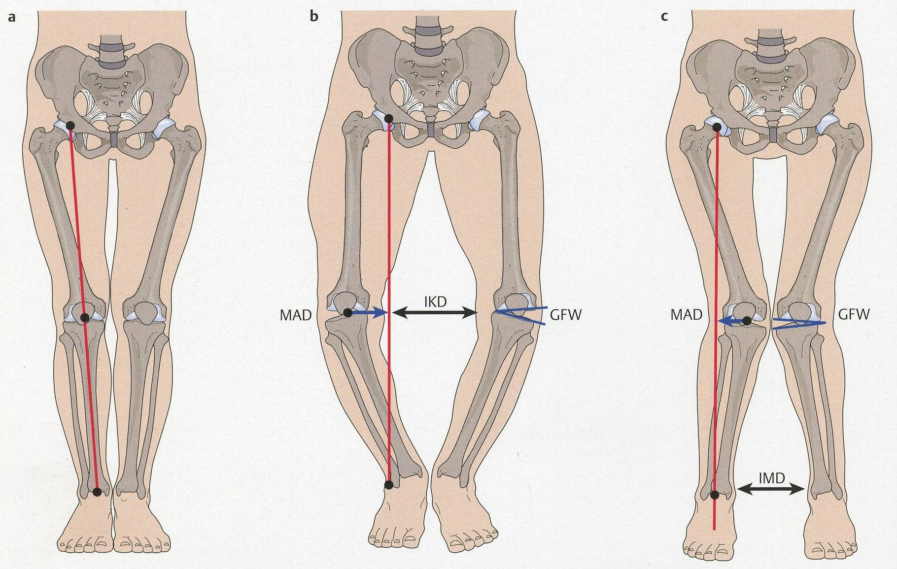 Beinachsenkorrektur (Umstellungsosteotomie) orthoclinics Webseite!